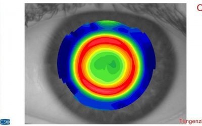 Topografia corneale computerizzata Roma