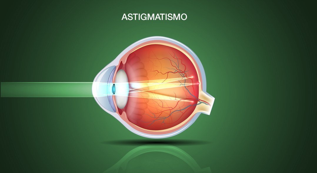 astigmatismo roma ottica fava