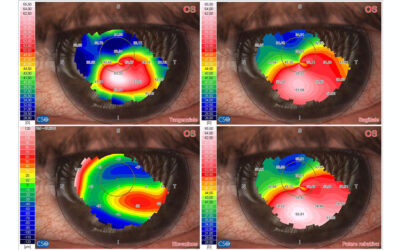RISOLUZIONE CHERATOCONO BILATERALE con LENTI SCLERALI